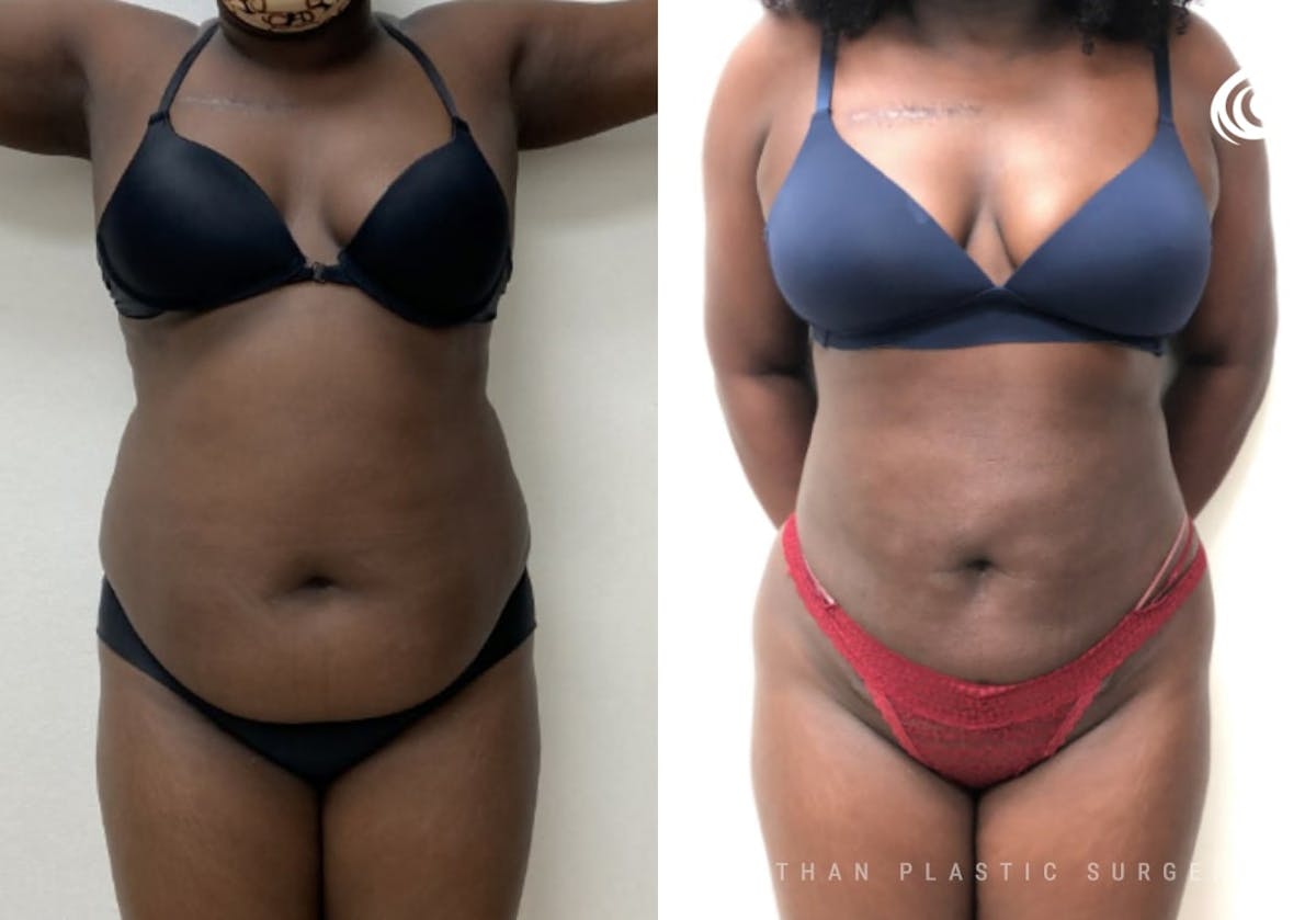 360 Liposuction Before & After Gallery - Patient 305109 - Image 1