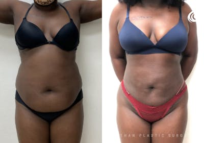 360 Liposuction Before & After Gallery - Patient 305109 - Image 1