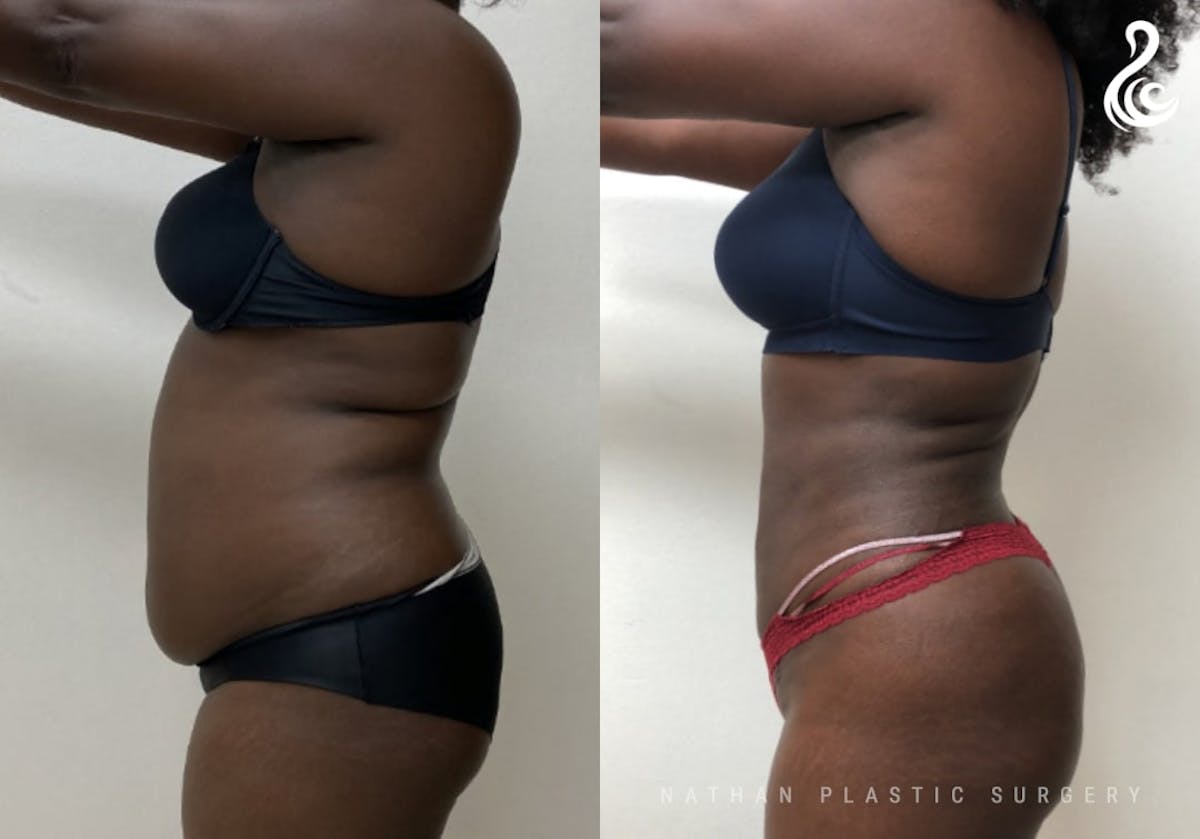 360 Liposuction Before & After Gallery - Patient 305109 - Image 2