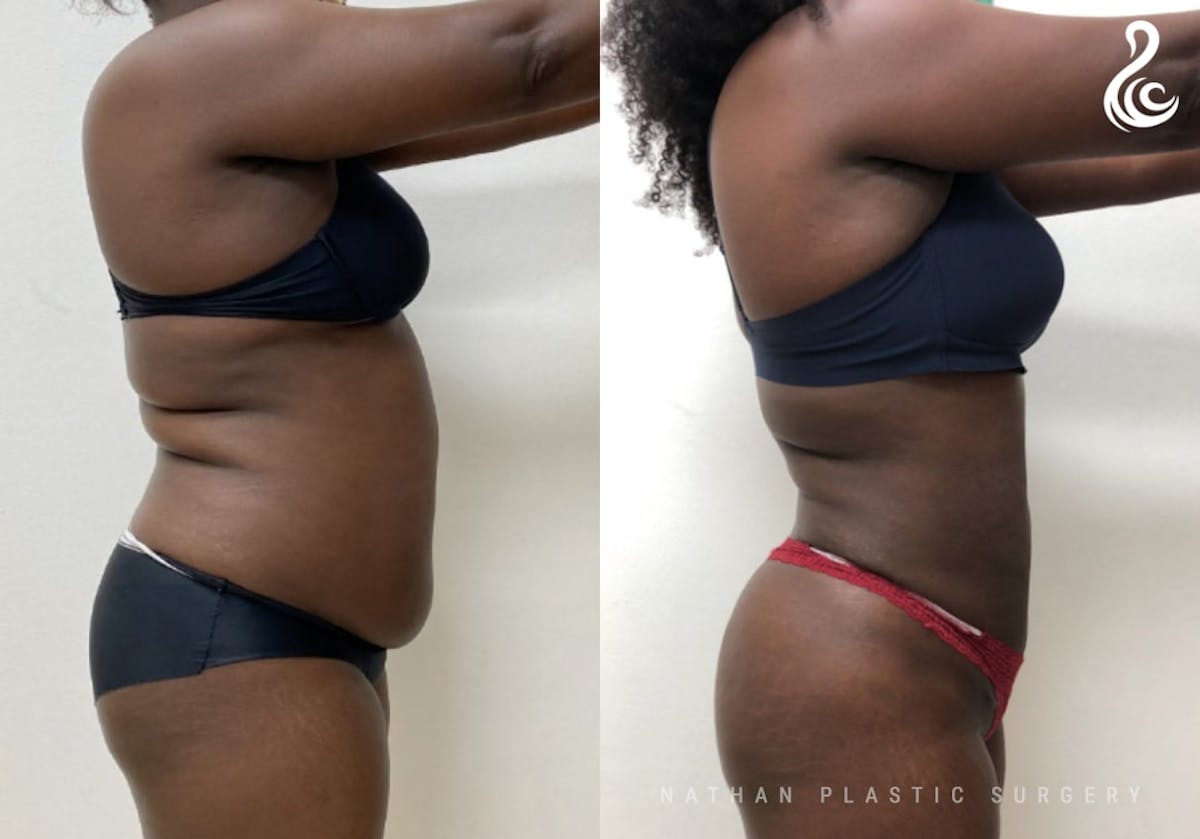 360 Liposuction Before & After Gallery - Patient 305109 - Image 3
