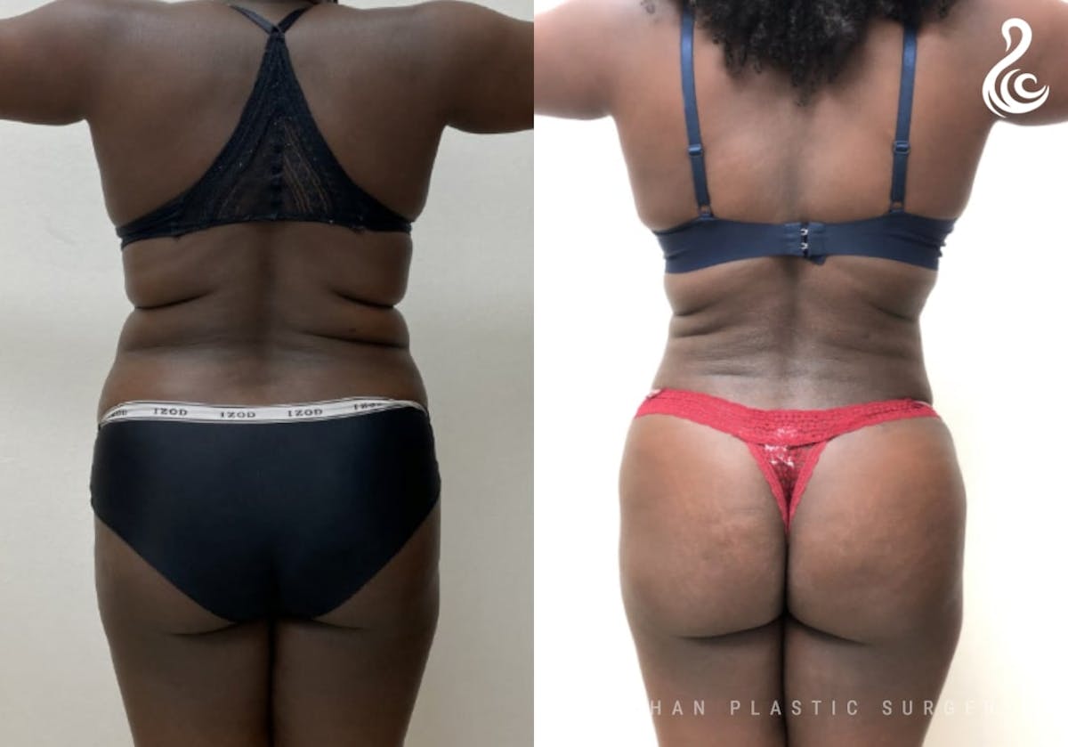 360 Liposuction Before & After Gallery - Patient 305109 - Image 4