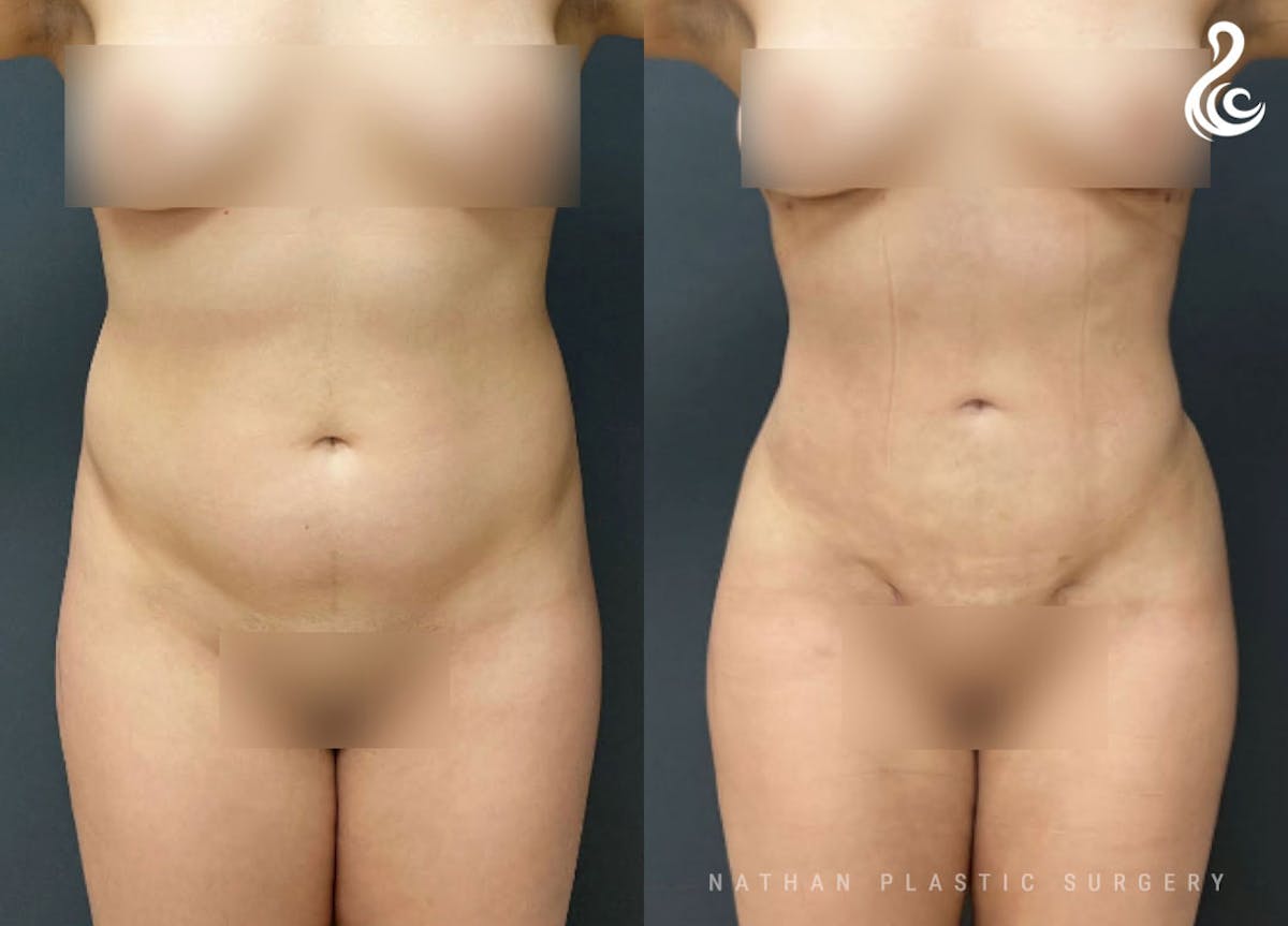 360 Liposuction Before & After Gallery - Patient 252809 - Image 1