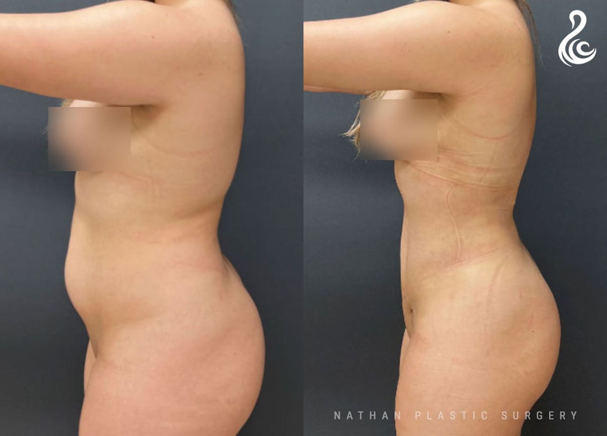 360 Liposuction Before & After Gallery - Patient 252809 - Image 2