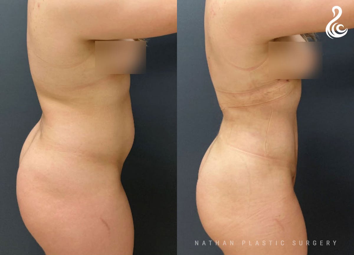360 Liposuction Before & After Gallery - Patient 252809 - Image 3
