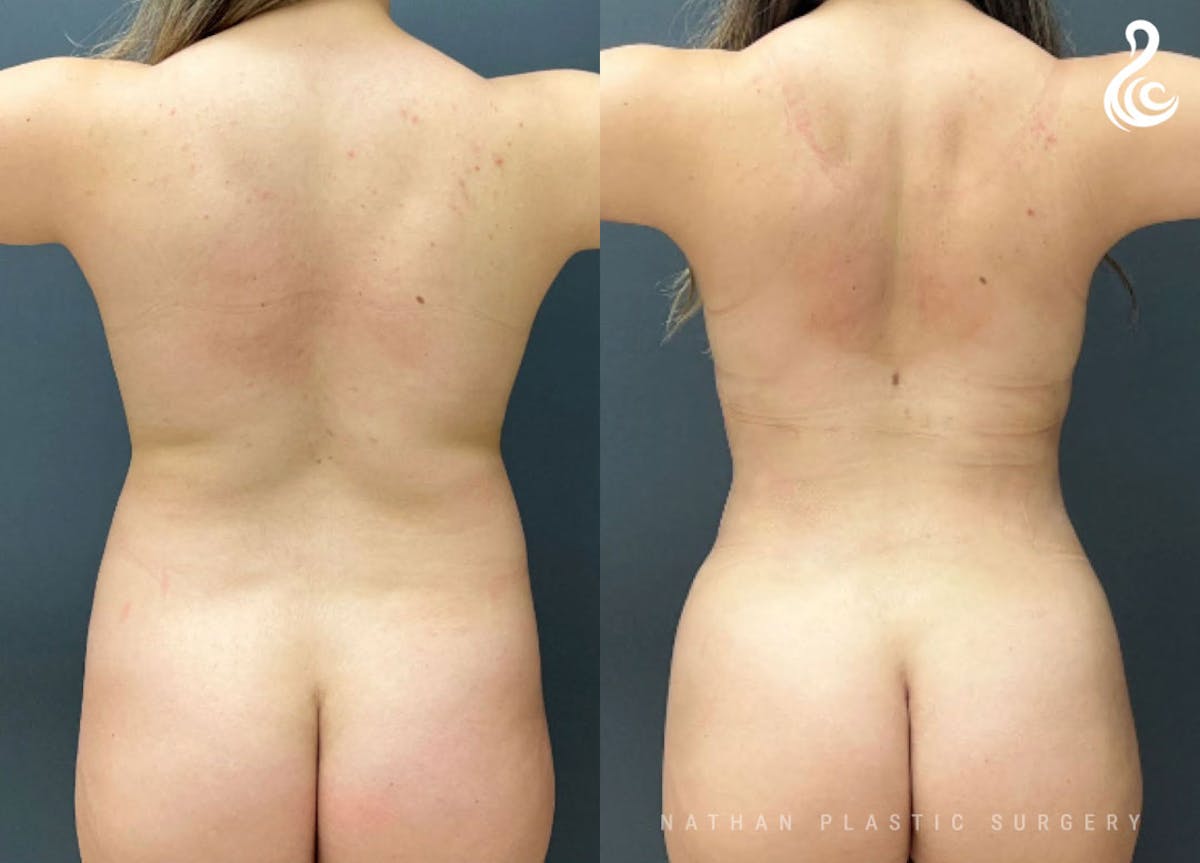 360 Liposuction Before & After Gallery - Patient 252809 - Image 4