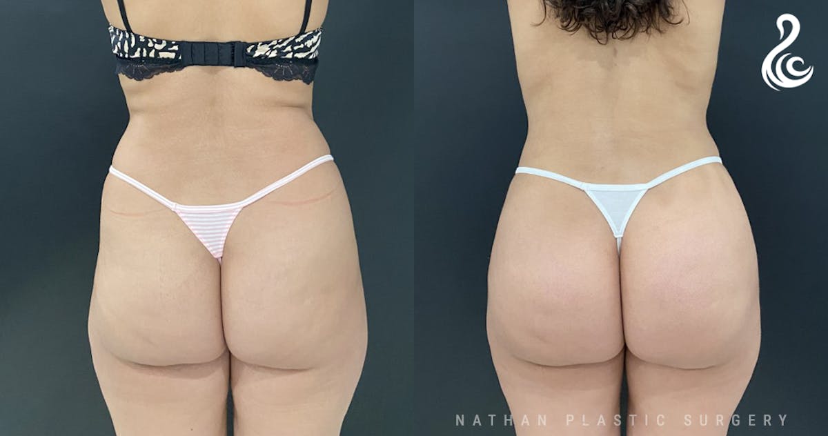 Brazilian Butt Lift (BBL) Before & After Gallery - Patient 774342 - Image 1