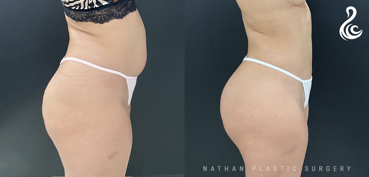 Brazilian Butt Lift (BBL) Before & After Gallery - Patient 774342 - Image 2