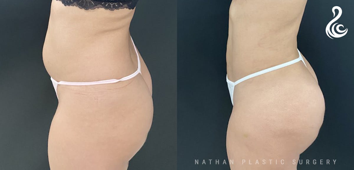Brazilian Butt Lift (BBL) Before & After Gallery - Patient 774342 - Image 3