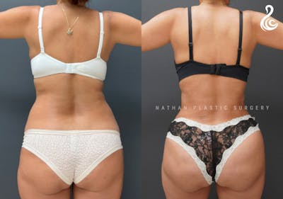 Brazilian Butt Lift (BBL) Before & After Gallery - Patient 877551 - Image 1