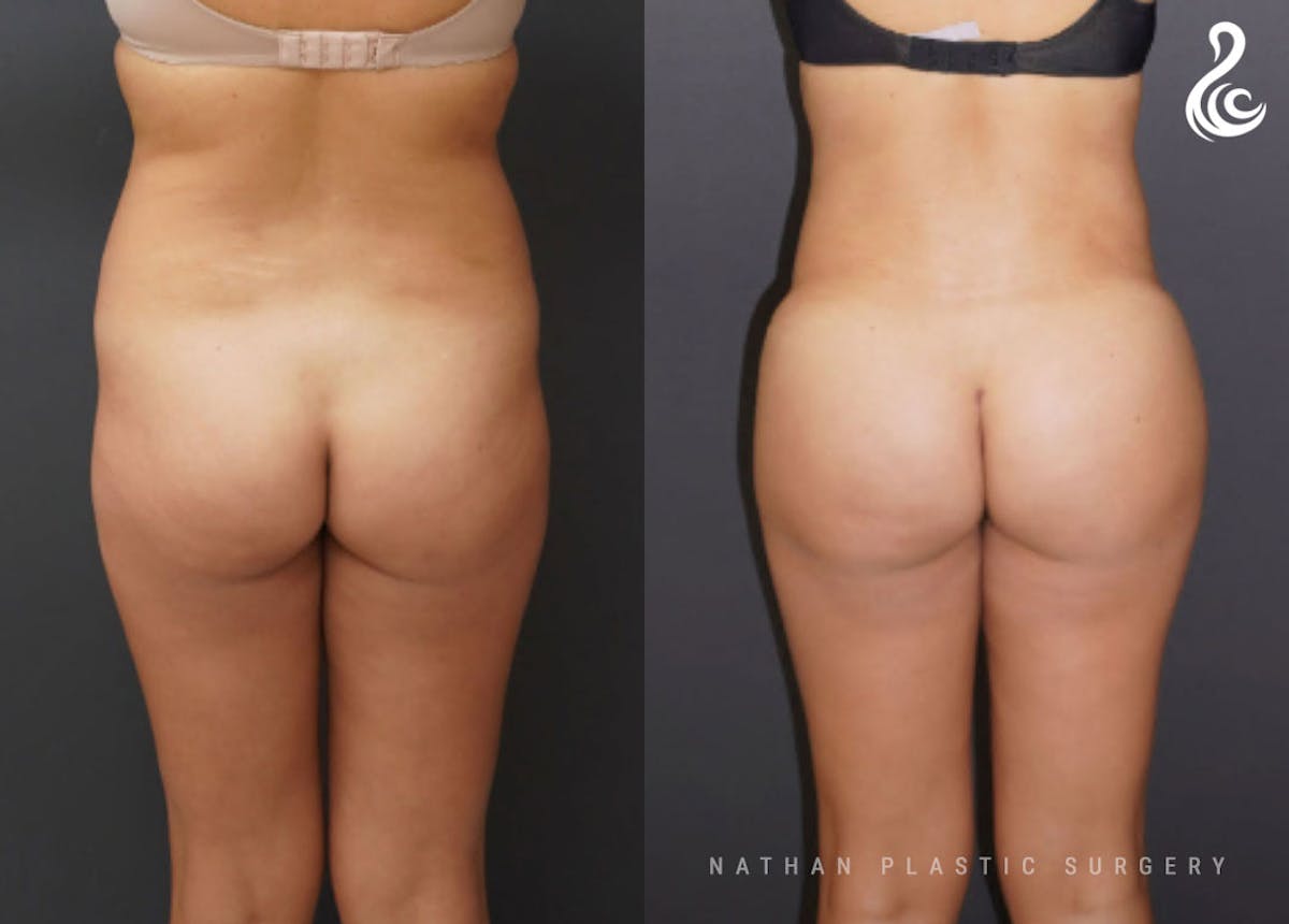 Brazilian Butt Lift (BBL) Before & After Gallery - Patient 902372 - Image 1