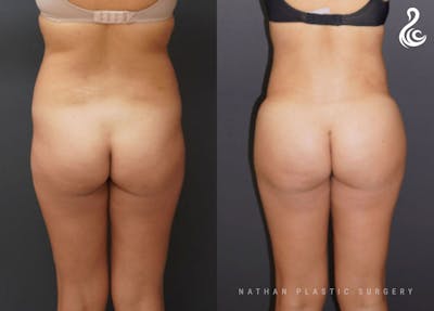 Brazilian Butt Lift (BBL) Before & After Gallery - Patient 902372 - Image 1