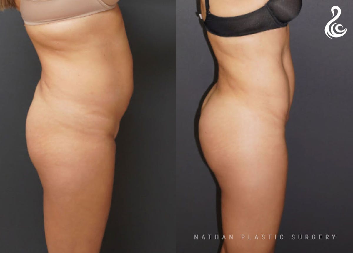 Brazilian Butt Lift (BBL) Before & After Gallery - Patient 902372 - Image 2