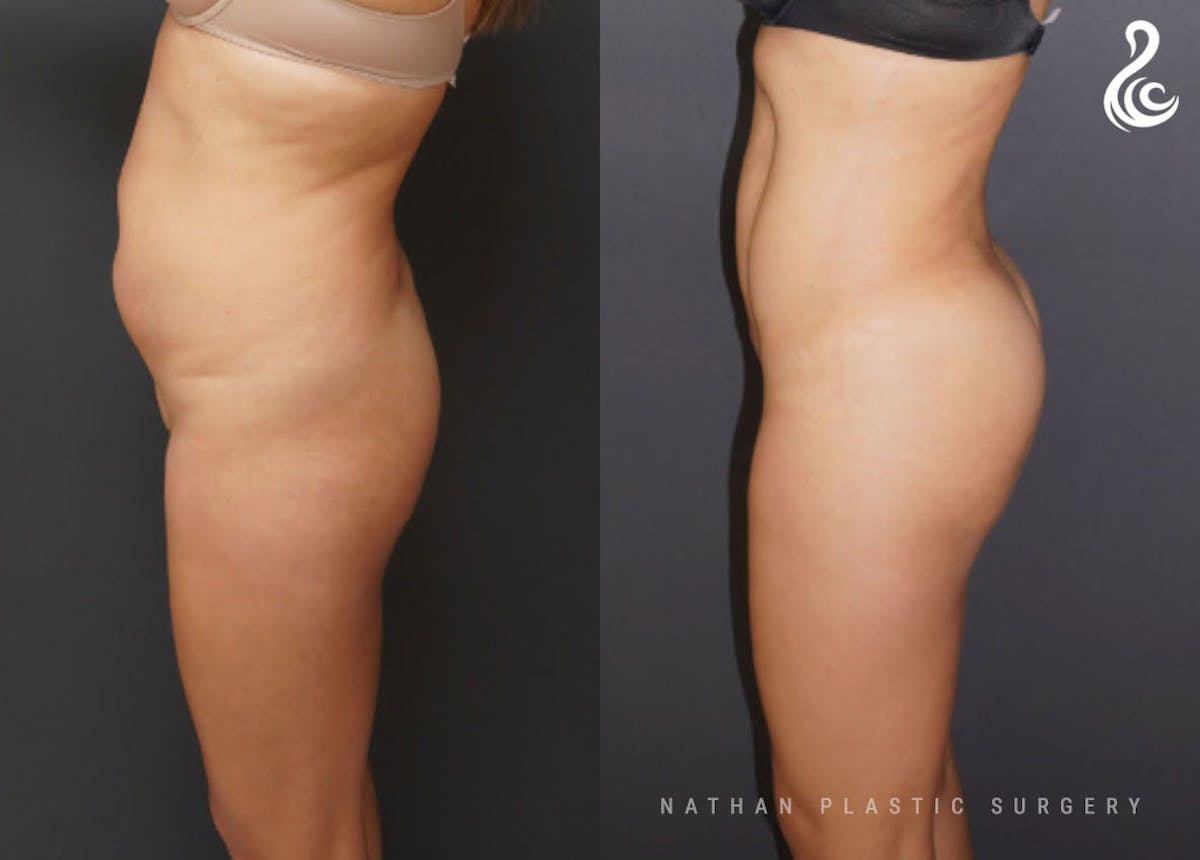Brazilian Butt Lift (BBL) Before & After Gallery - Patient 902372 - Image 3