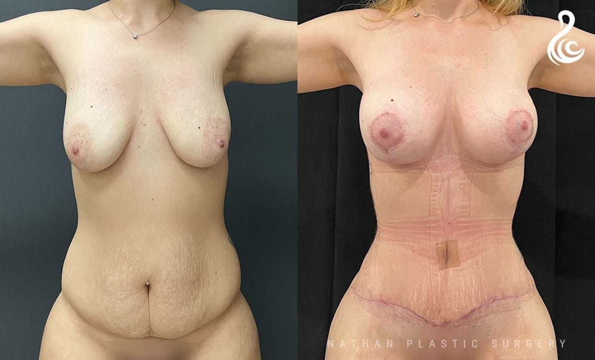 Tummy Tuck Before & After Gallery - Patient 853933 - Image 1