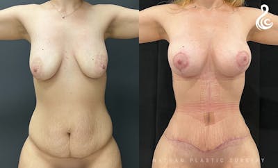 Tummy Tuck Before & After Gallery - Patient 853933 - Image 1