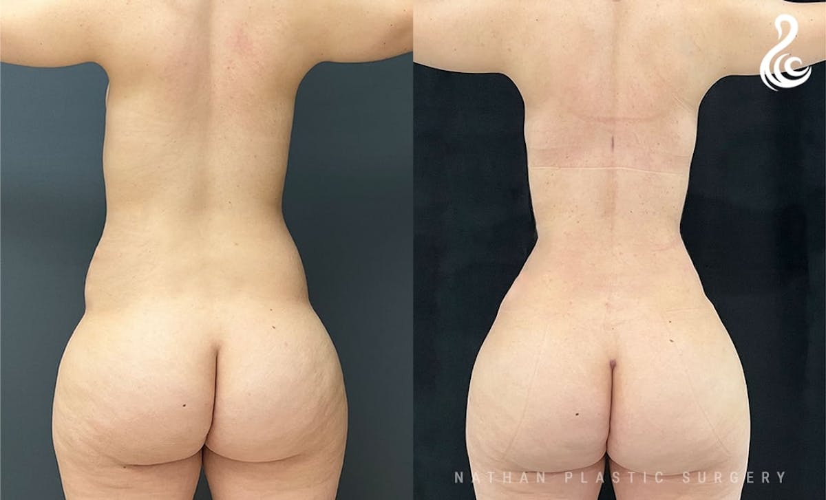 Tummy Tuck Before & After Gallery - Patient 853933 - Image 2