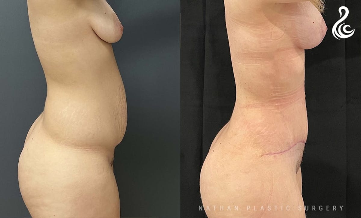 Tummy Tuck Before & After Gallery - Patient 853933 - Image 3