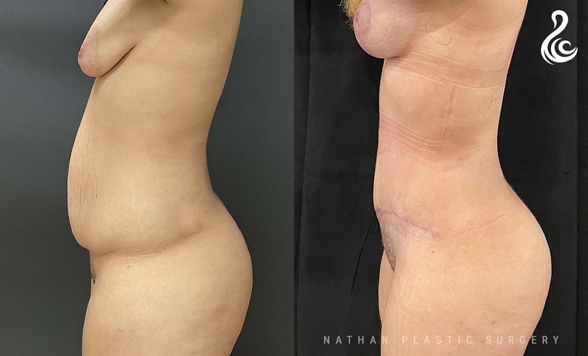 Tummy Tuck Before & After Gallery - Patient 853933 - Image 4