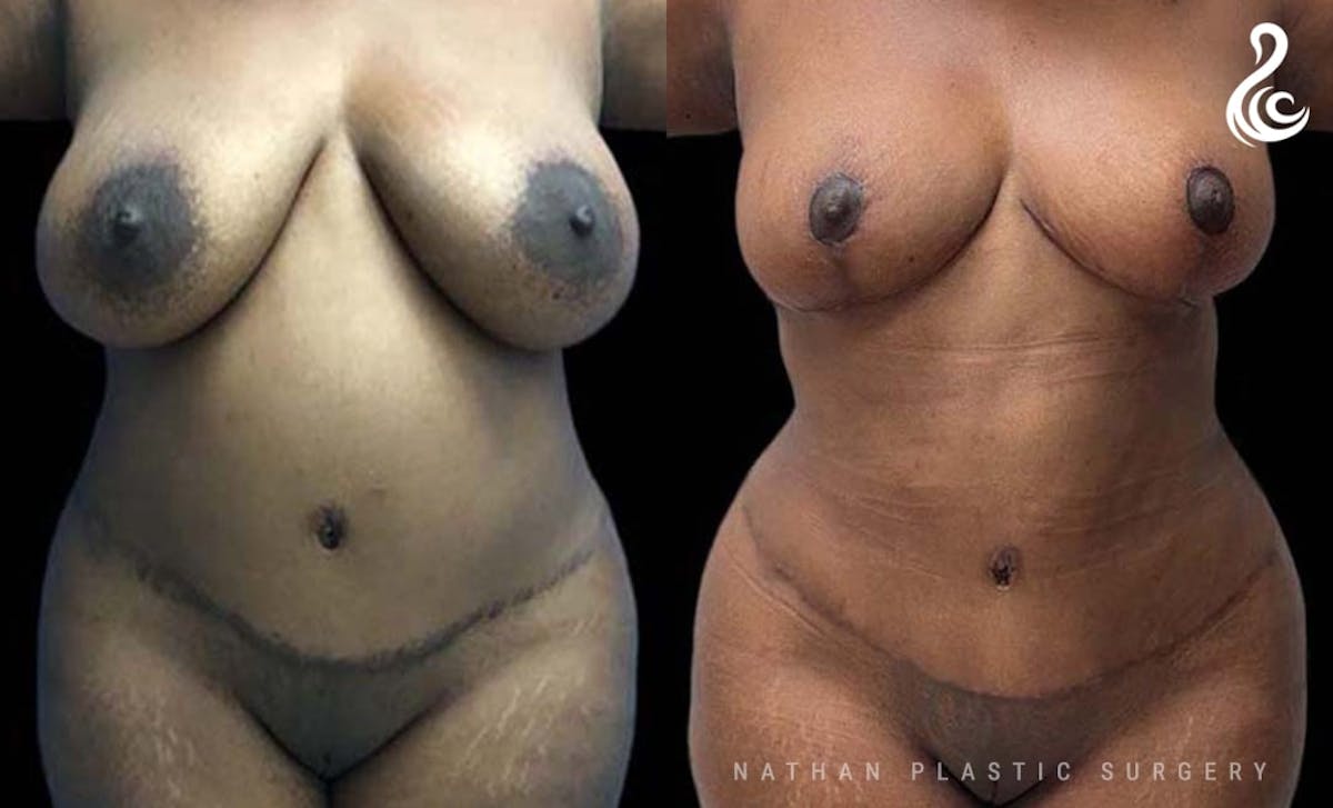 Tummy Tuck Before & After Gallery - Patient 375442 - Image 1