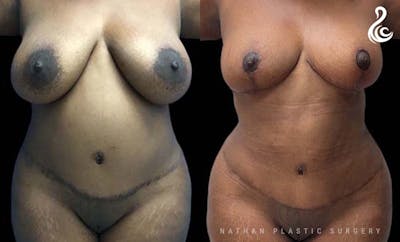 Tummy Tuck Before & After Gallery - Patient 375442 - Image 1