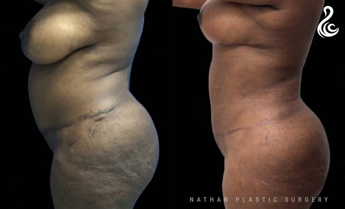 Tummy Tuck Before & After Gallery - Patient 375442 - Image 3