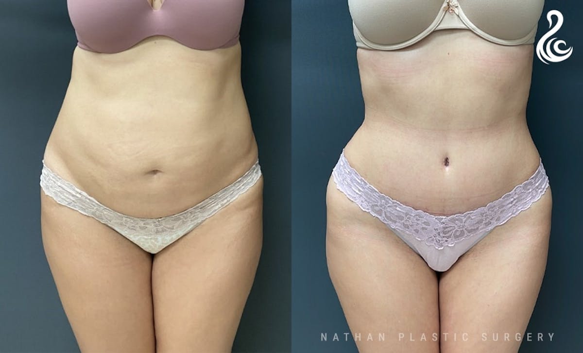 Tummy Tuck Before & After Gallery - Patient 200138 - Image 1