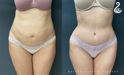 Tummy Tuck Before & After Gallery - Patient 200138 - Image 1
