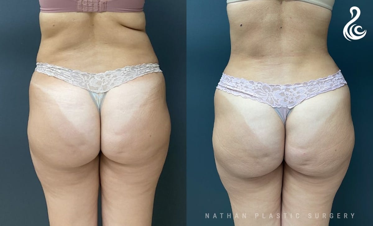 Tummy Tuck Before & After Gallery - Patient 200138 - Image 2