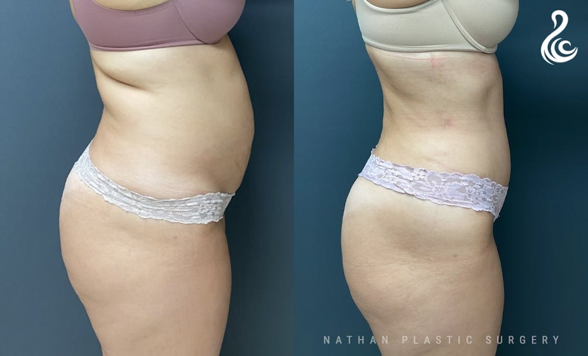Tummy Tuck Before & After Gallery - Patient 200138 - Image 3