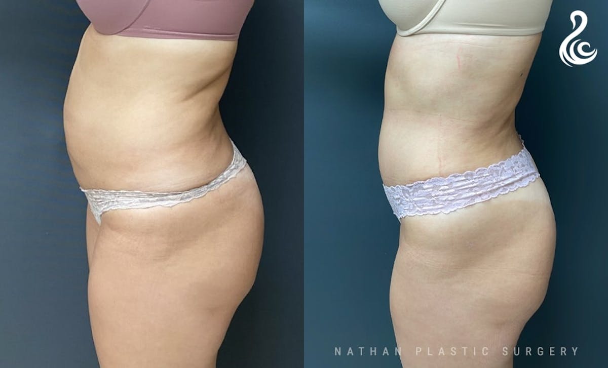 Tummy Tuck Before & After Gallery - Patient 200138 - Image 4