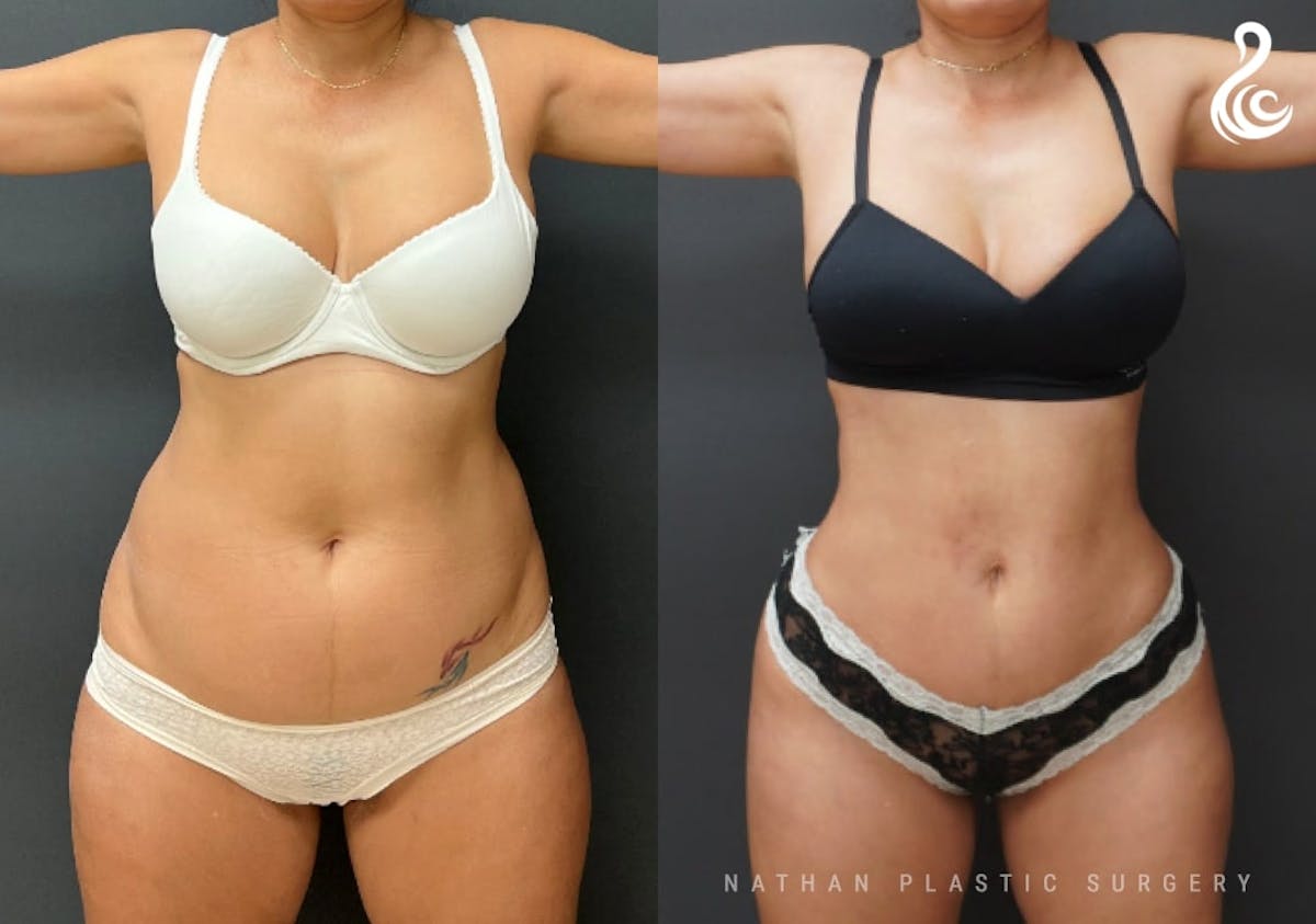 Tummy Tuck Before & After Gallery - Patient 382410 - Image 1