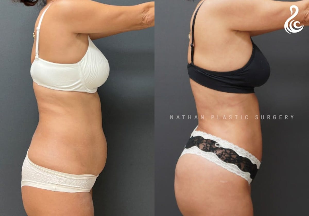 Tummy Tuck Before & After Gallery - Patient 382410 - Image 2