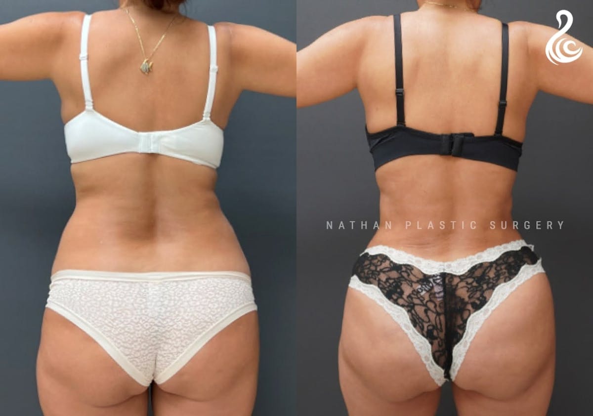 Tummy Tuck Before & After Gallery - Patient 382410 - Image 3