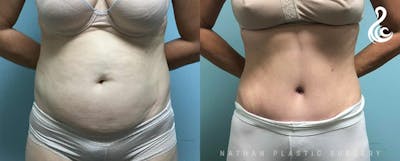Tummy Tuck Before & After Gallery - Patient 622278 - Image 1