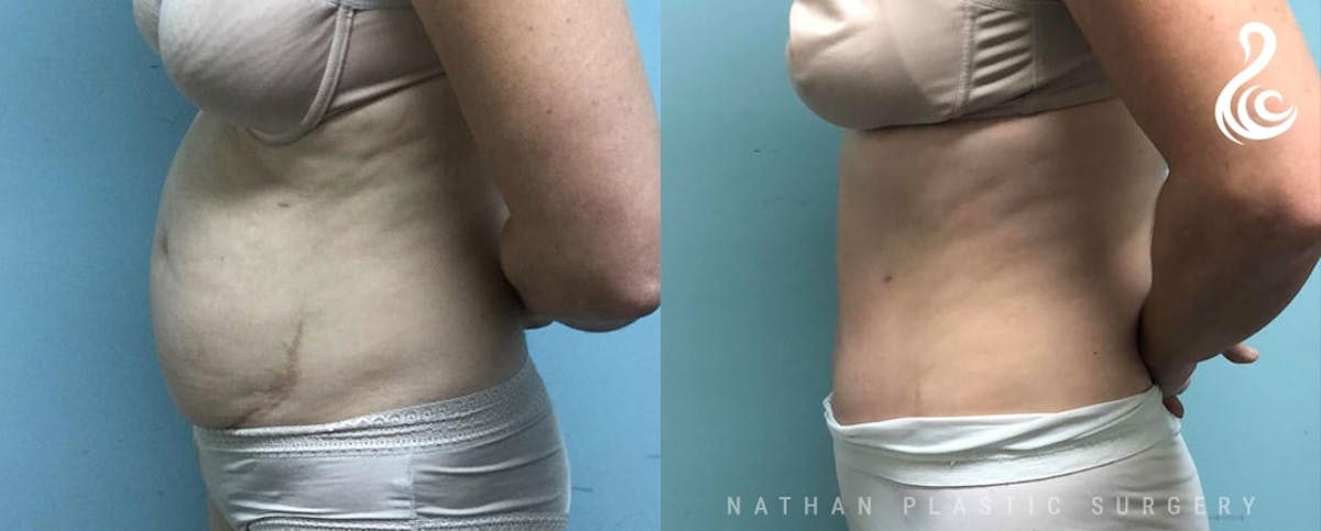 Tummy Tuck Before & After Gallery - Patient 622278 - Image 2