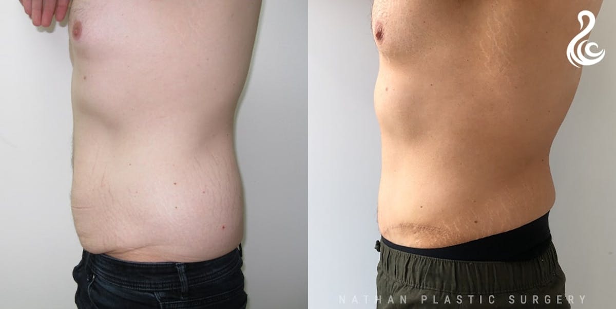 Tummy Tuck Before & After Gallery - Patient 110686 - Image 1
