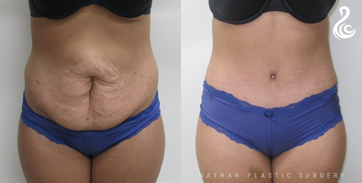 Tummy Tuck Before & After Gallery - Patient 188244 - Image 1