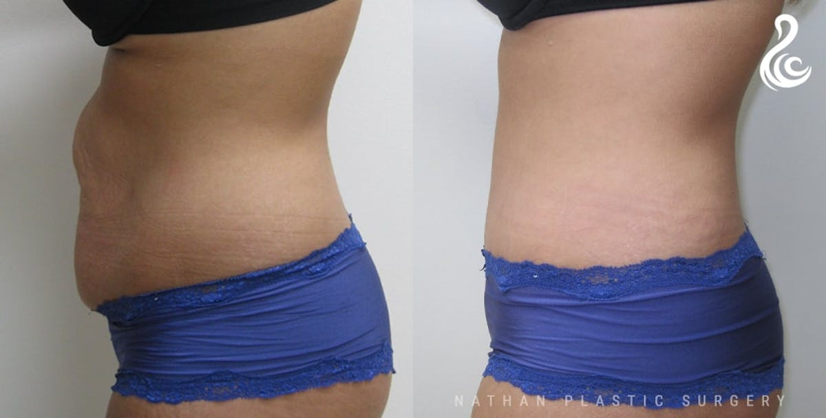 Tummy Tuck Before & After Gallery - Patient 188244 - Image 2