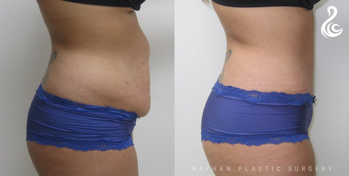 Tummy Tuck Before & After Gallery - Patient 188244 - Image 3