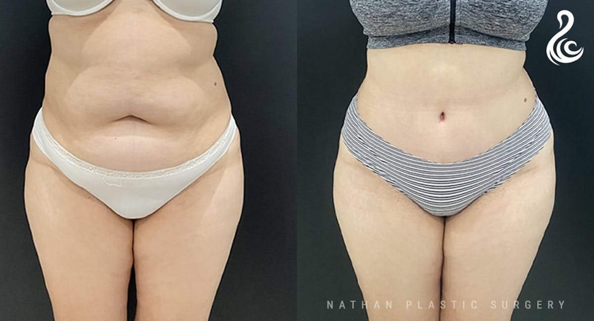 Tummy Tuck Before & After Gallery - Patient 211415 - Image 1