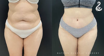 Tummy Tuck Before & After Gallery - Patient 211415 - Image 1