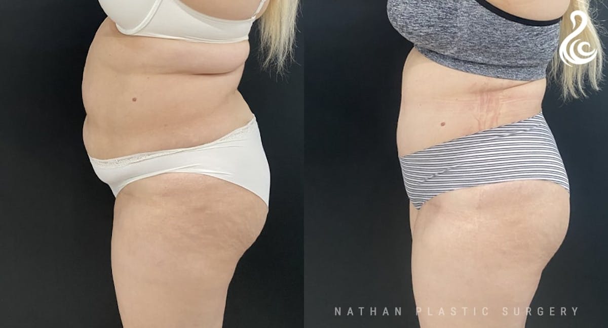 Tummy Tuck Before & After Gallery - Patient 211415 - Image 2