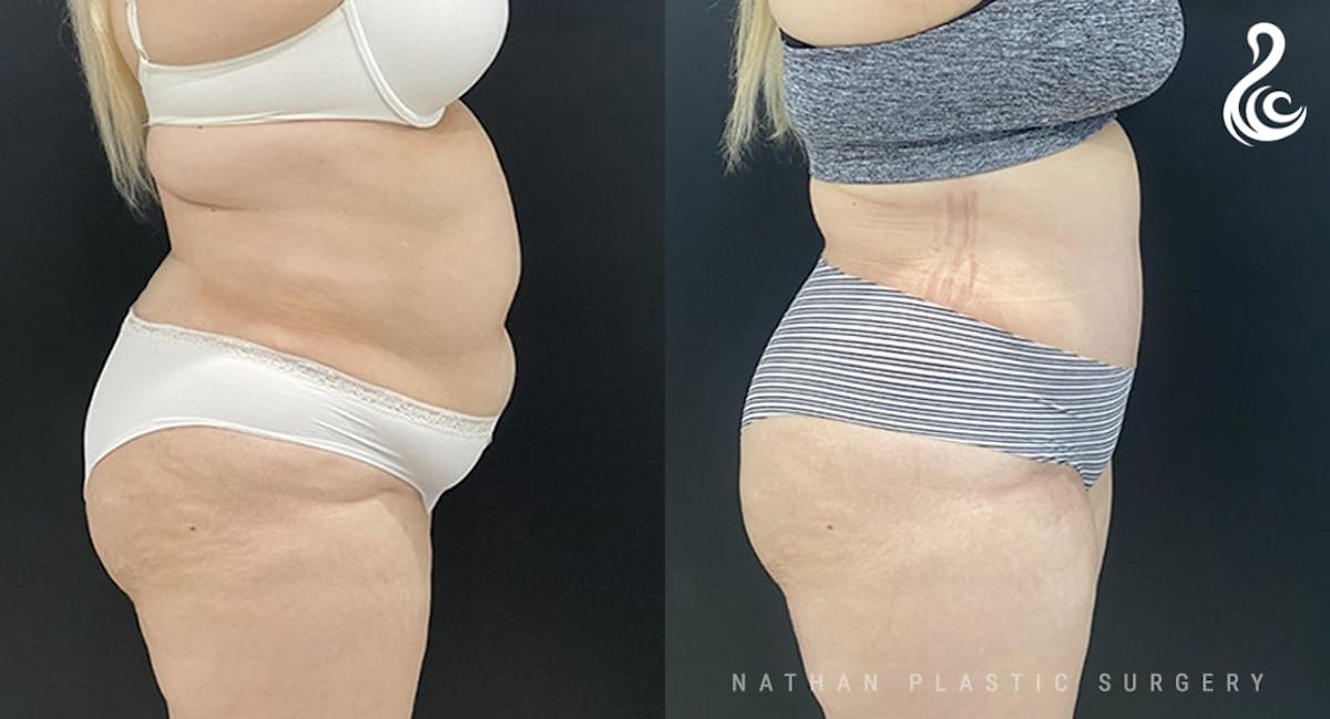 Tummy Tuck Before & After Gallery - Patient 211415 - Image 3
