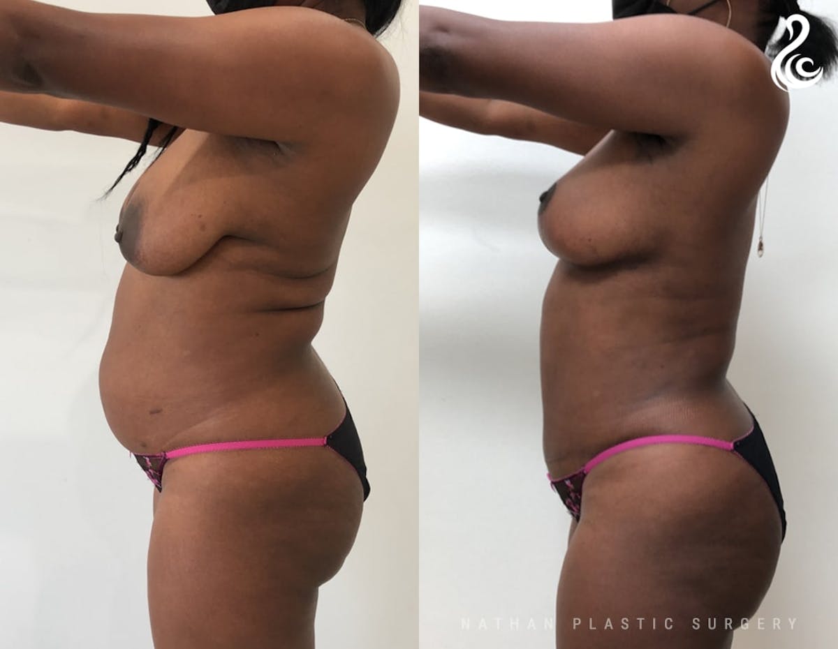 Tummy Tuck Before & After Gallery - Patient 259346 - Image 3