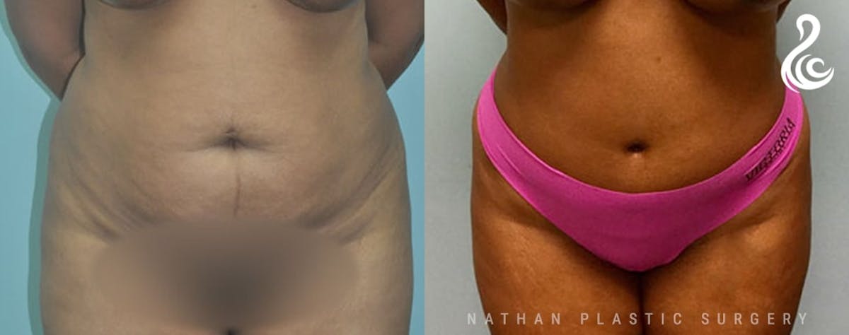 Tummy Tuck Before & After Gallery - Patient 967351 - Image 1