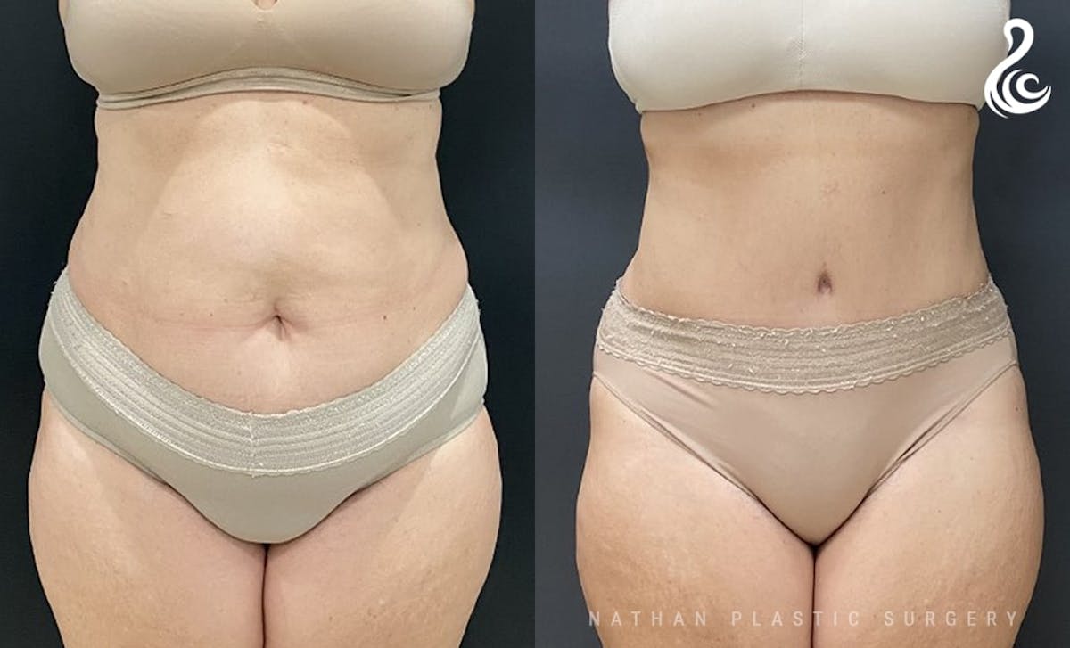 Tummy Tuck Before & After Gallery - Patient 386527 - Image 1