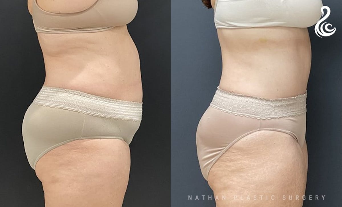 Tummy Tuck Before & After Gallery - Patient 386527 - Image 2