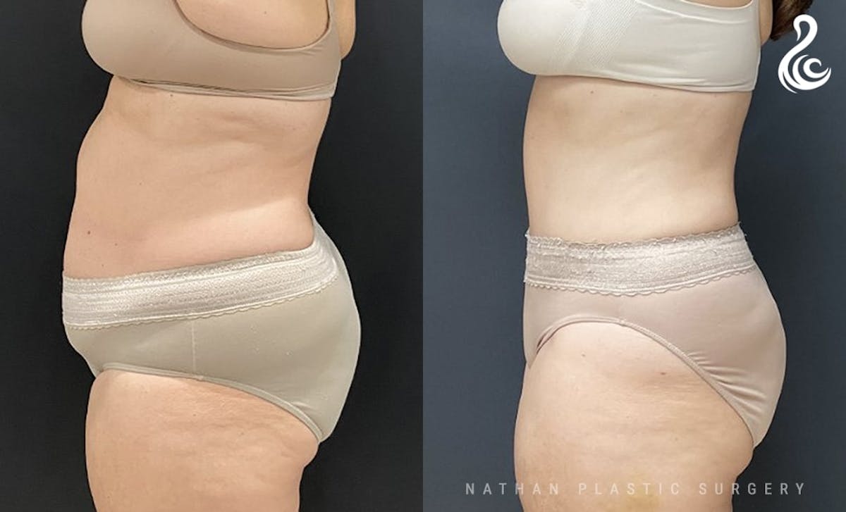 Tummy Tuck Before & After Gallery - Patient 386527 - Image 3