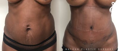 Tummy Tuck Before & After Gallery - Patient 245224 - Image 1