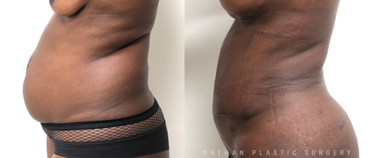 Tummy Tuck Before & After Gallery - Patient 245224 - Image 2
